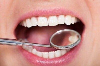 White Fillings for a beautiful smile. 