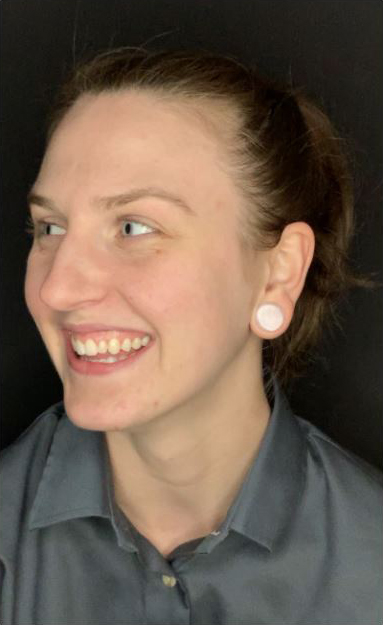 Allison E Before – e Digital Smile Design