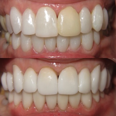 How Well Does LED Teeth Whitening Work?