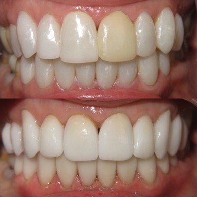 How Well Does LED Teeth Whitening Work? How Well Does LED Teeth Whitening Work?