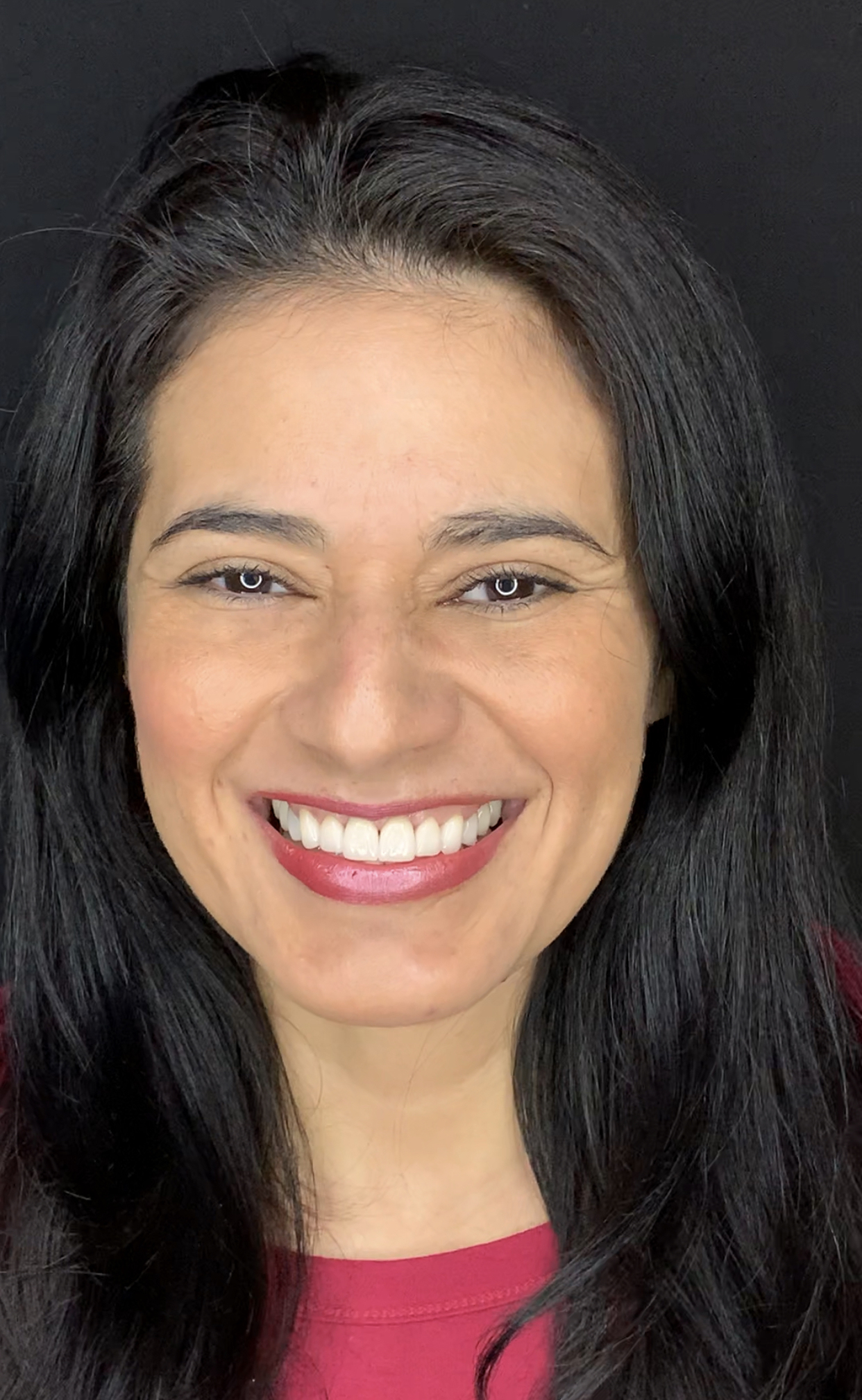 1 porcelain veneers