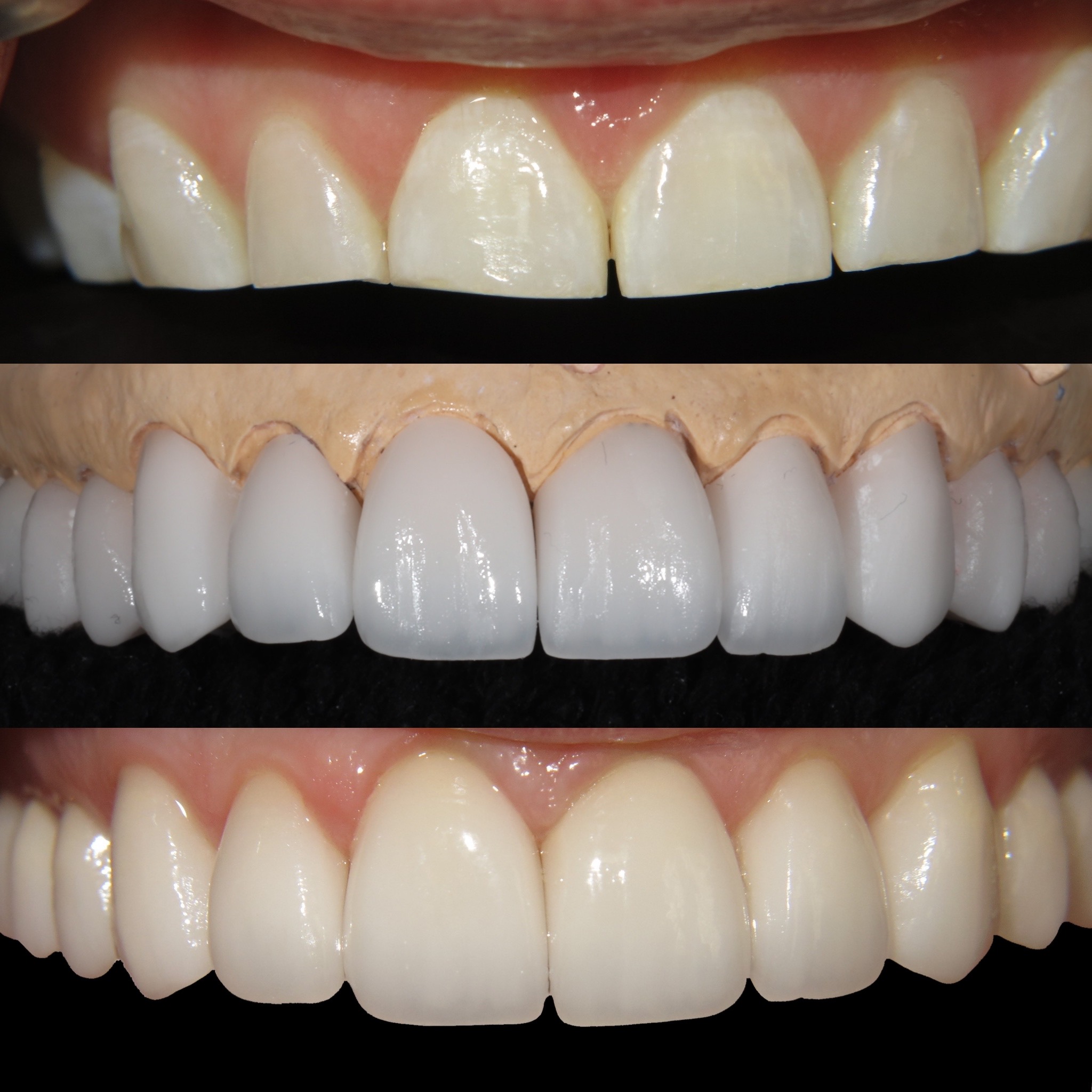 4 veneers