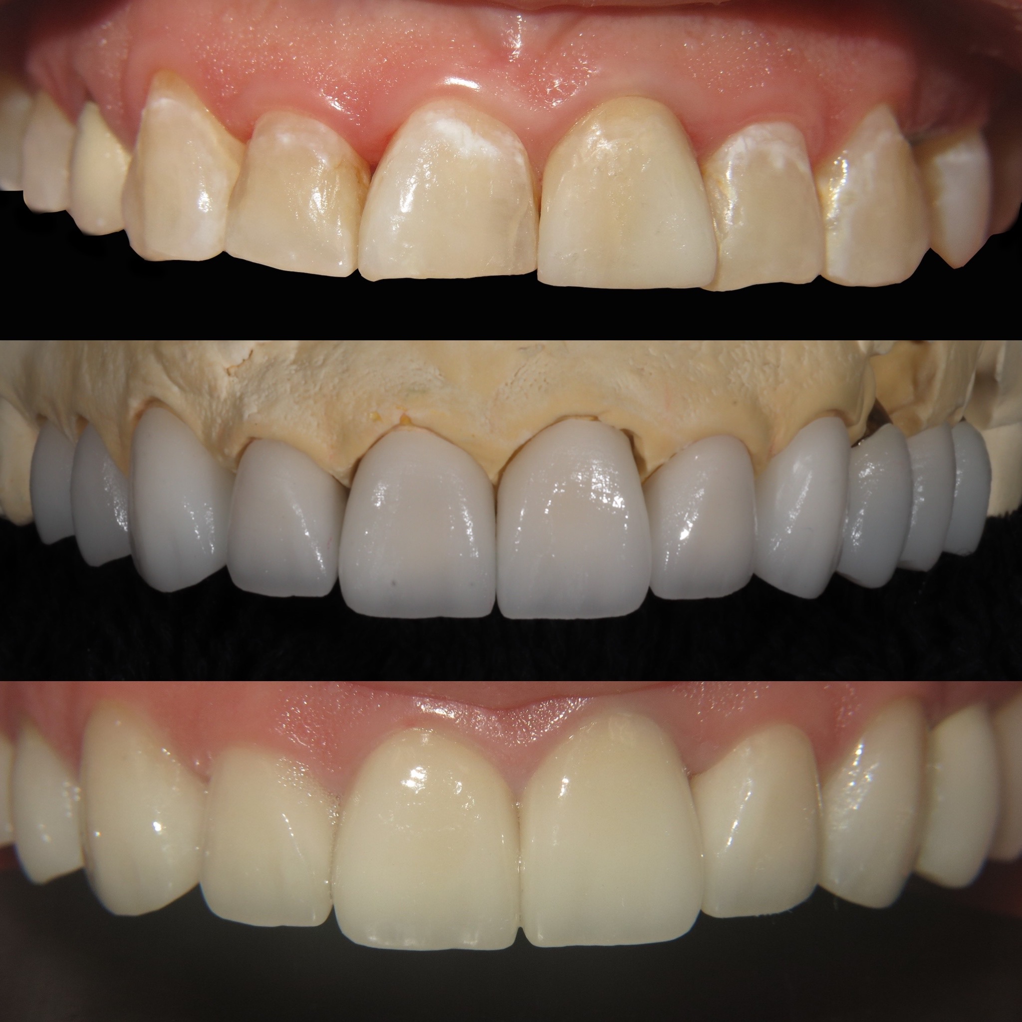 6 porcelain veneers